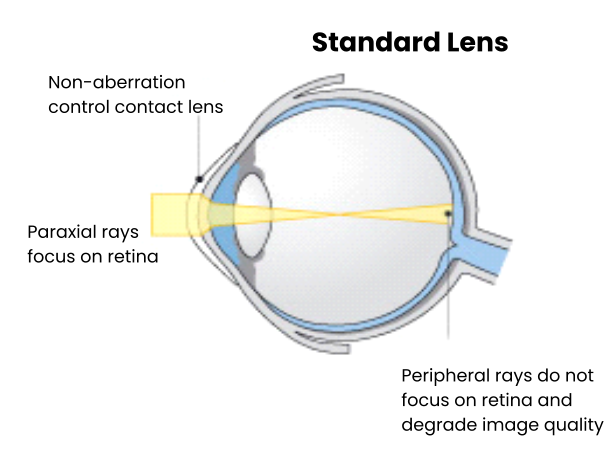 Standard Lens Non-aberration control contact lens Paraxial rays focus on retina Peripheral rays do not focus on retina and degrade image quality